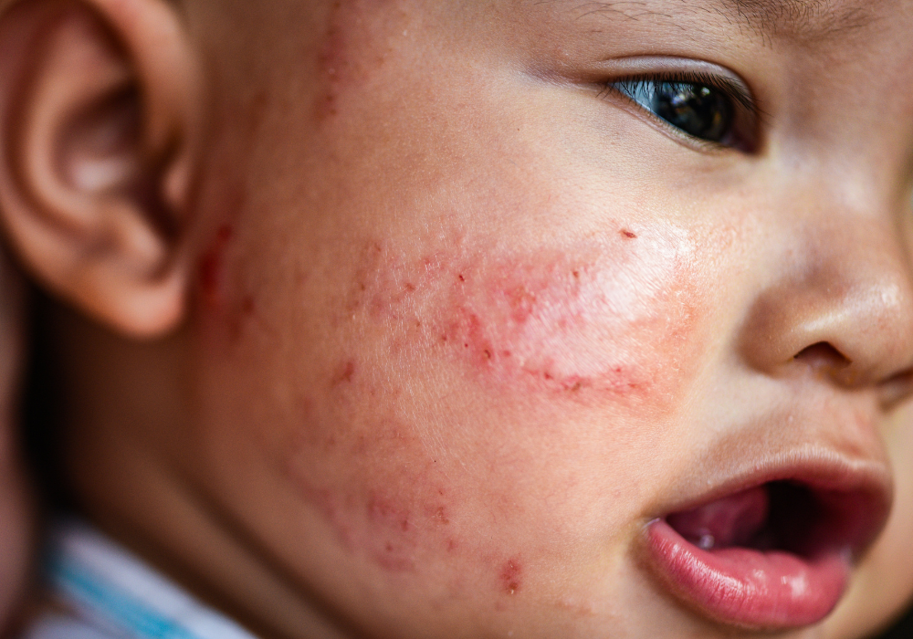 Tips for Bathing a Baby with Eczema