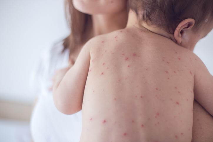 Allergies in Babies